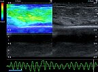 Ultraschall-Elastographie – Subkutanes infantiles Hämangiom