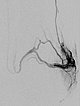 Digitale Subtraktionsangiographie – Parkes-Weber-Syndrom am Bein