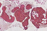 Histopathologie EvG-Färbung – Intramuskuläre venöse Malformation