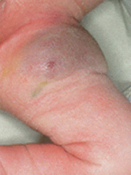 Non-Involuting Congential Hemangioma – Tumor in der linken Leiste (3. Tag)