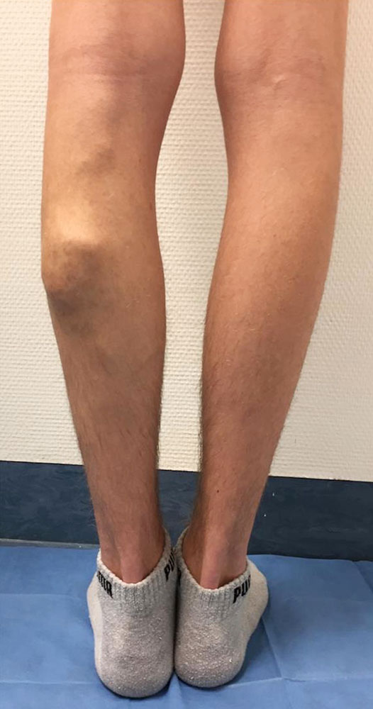 Arteriovenöse Malformation Bein