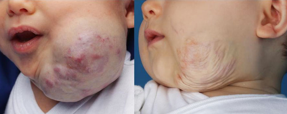 Kongenitales Hämangiom vom Rapidly Involuting Typ (RICH) bei einem Baby