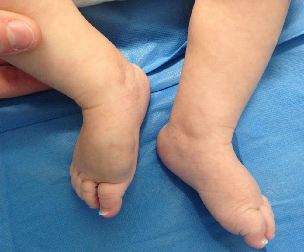 Kleinkind - Gefäßtumor am Fußrücken