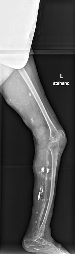 Röntgen-Nativaufnahme Bein