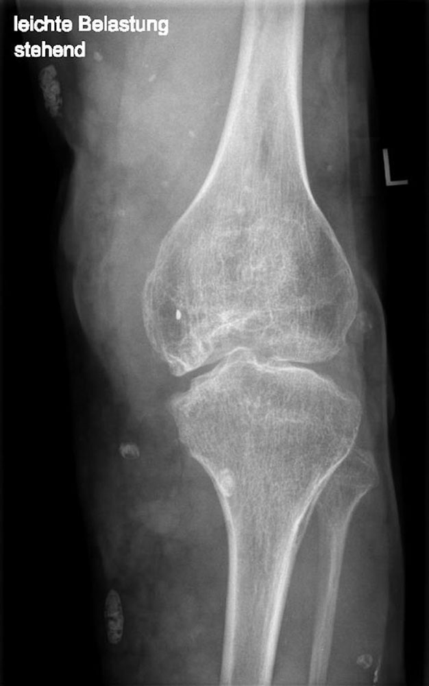 Röntgen-Nativaufnahme Minderwuchs Bein
