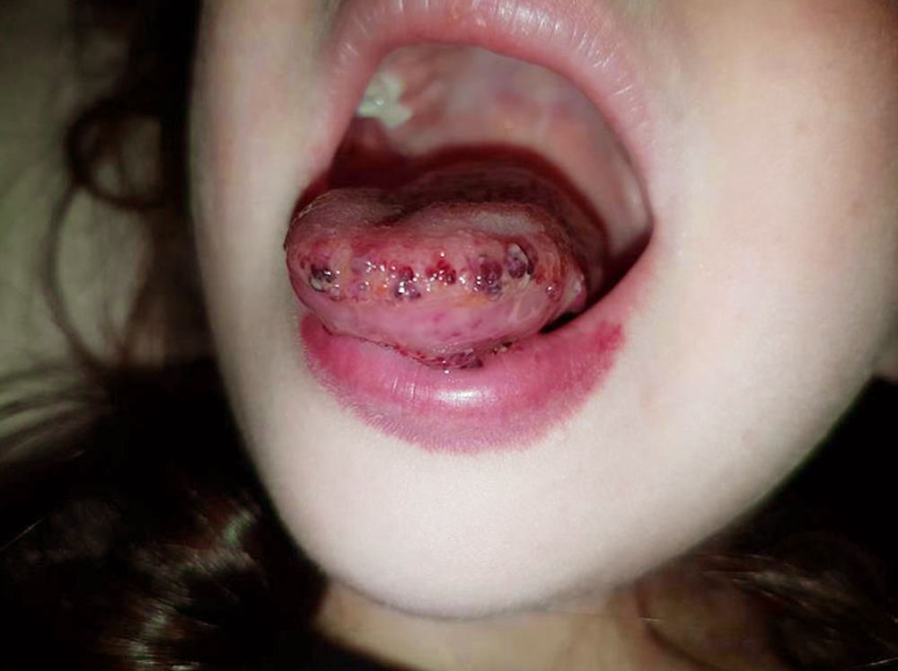 Kapillär-Lymphatische Malformation auf Zunge