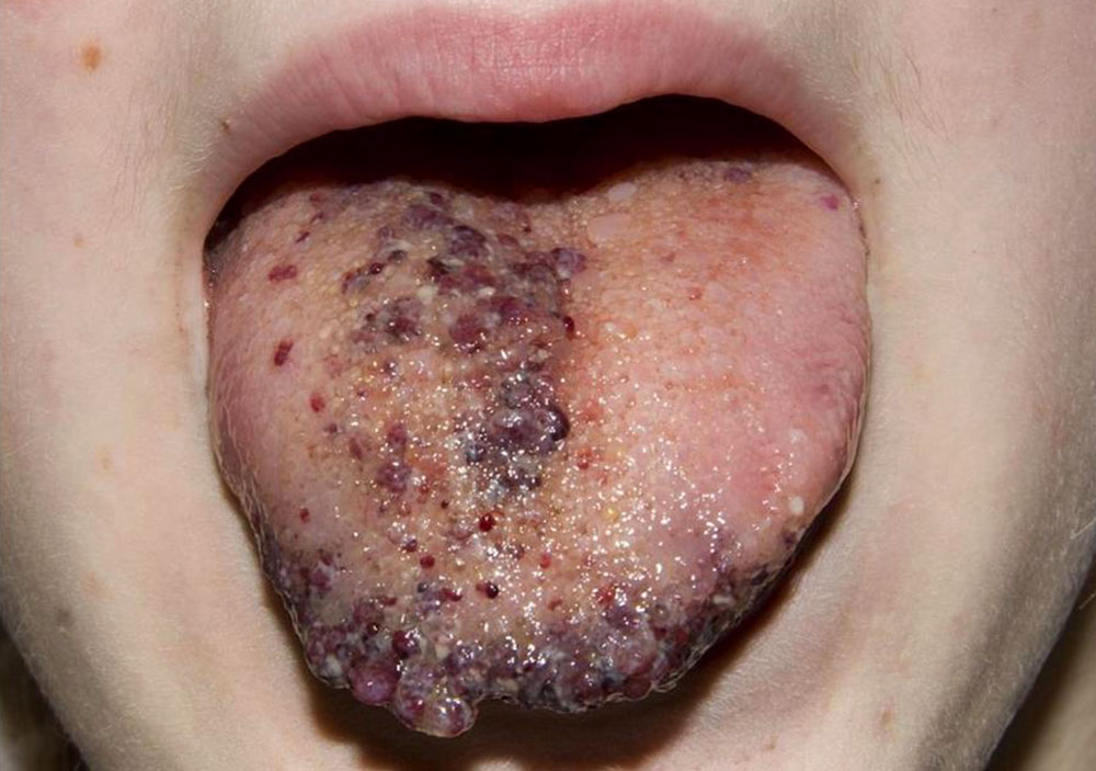 Lymphatische Malformation - Zunge