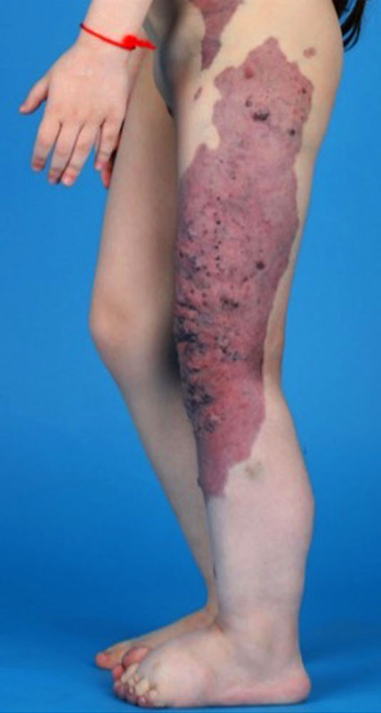Klippel-Trénaunay-Syndrom mit kapillärer Malformation