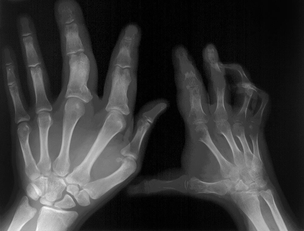 Röntgenbild – Hemihyperplasie multiple Lipomatose-Syndrom
