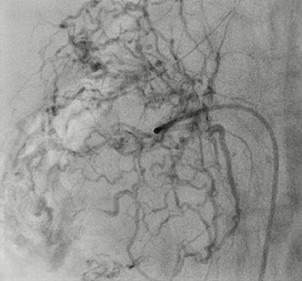Riesige arteriovenöse Malformation in der Leber bei Neugeborenem