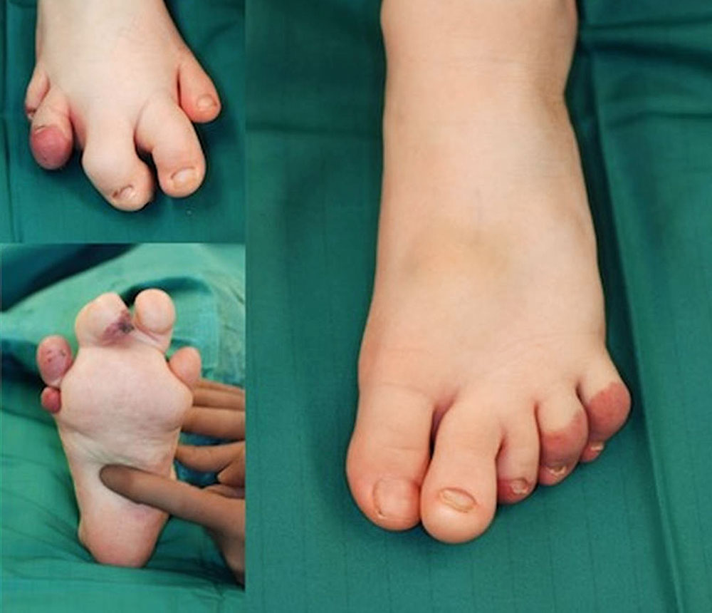 CLOVES-Syndrom und kombinierter kapillär-venolymphatischer Malformation an Fuß