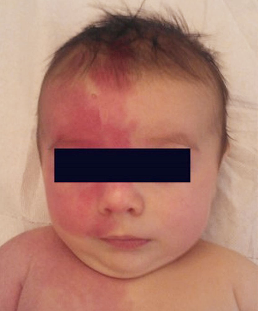 Säugling mit kapillärer Malformation der rechten Körperhälfte